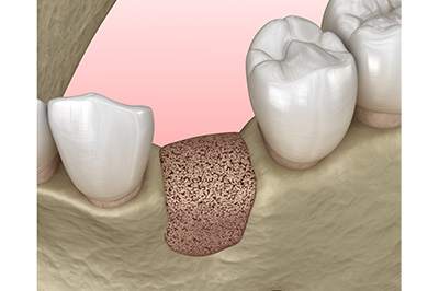 Gallavin Dentistry | Emergency Treatment, Crowns  amp  Caps and Implant Restorations