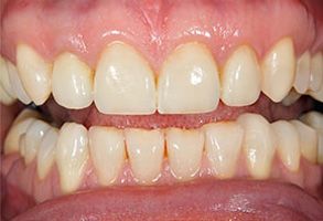 Gallavin Dentistry | Extractions, Teeth Whitening and Dentures